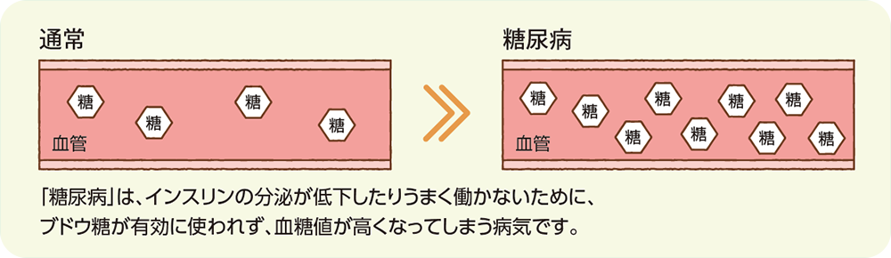 「糖尿病」は、インスリンの分泌が低下したりうまく働かないために、ブドウ糖が有効に使われず、血糖値が高くなってしまう病気です。